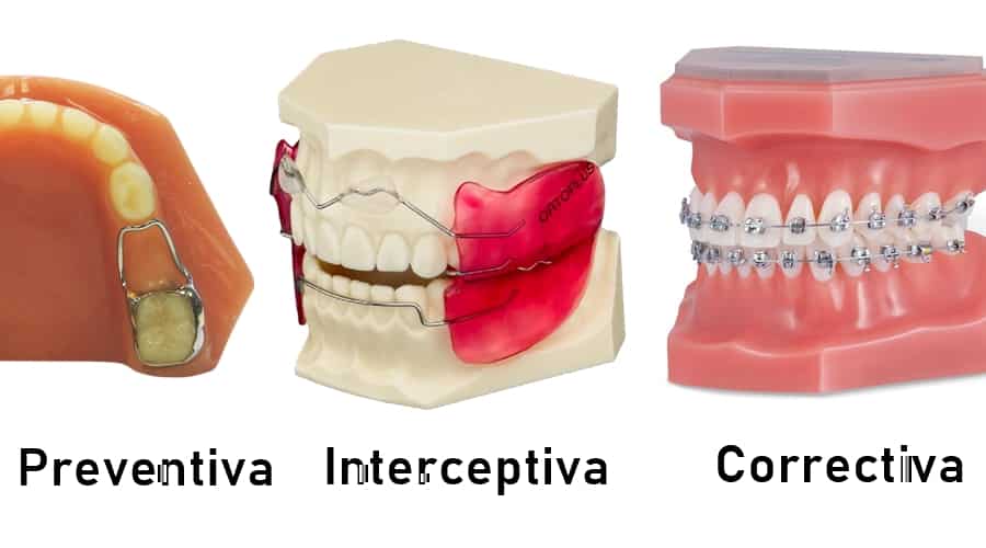 Tipos Ortodoncia